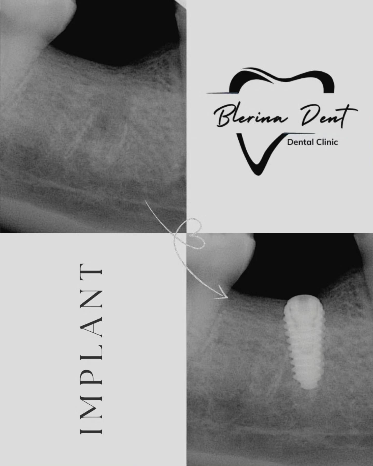Dental X-ray with Blerina Dent Dental Clinic logo and 'Implant' text.