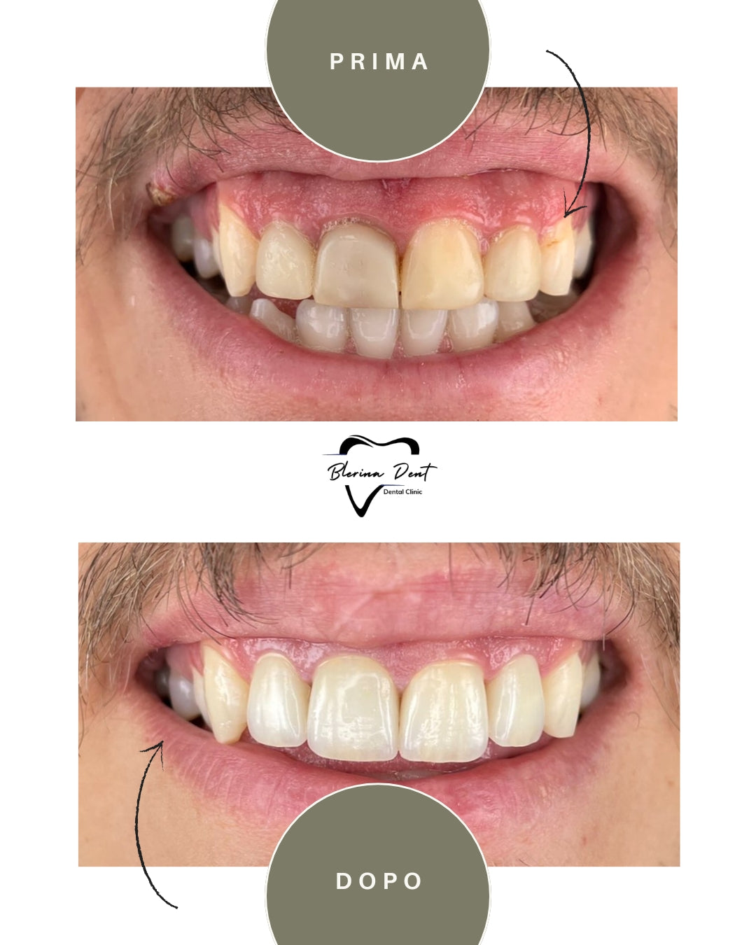 Corone in Zirconia Standard & Monolitica (full zirconia)