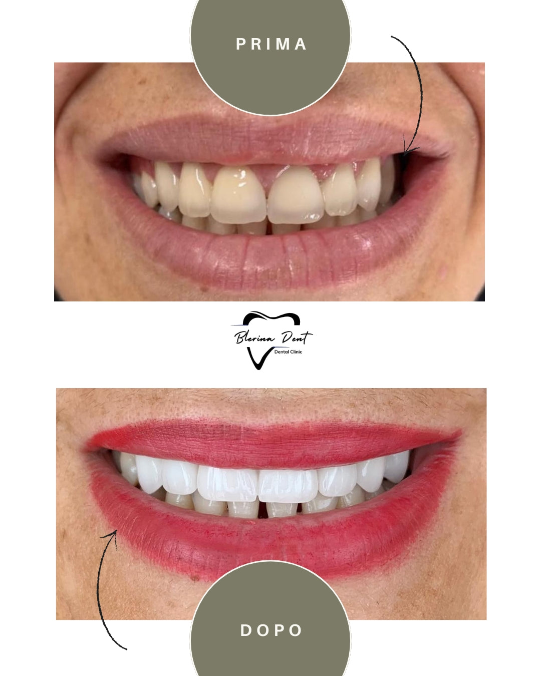Corone in Zirconia Standard & Monolitica (full zirconia)