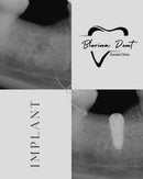 Implanti Dentali
