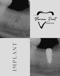 Implanti Dentali