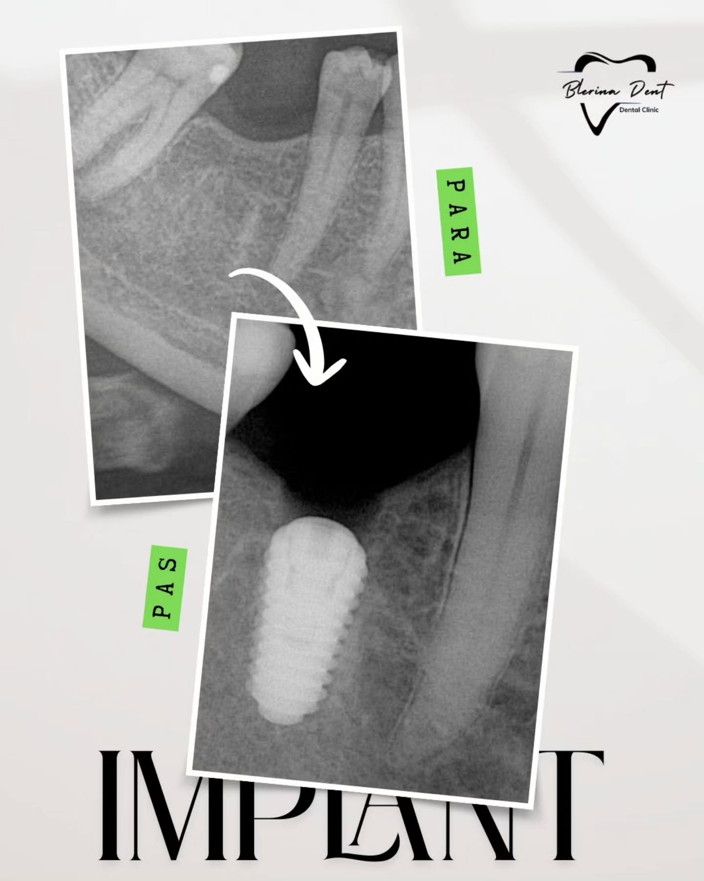 Implanti Dentali