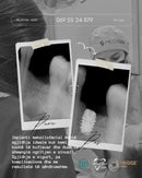 Person with dental implants shown in black and white images, with text overlay.
