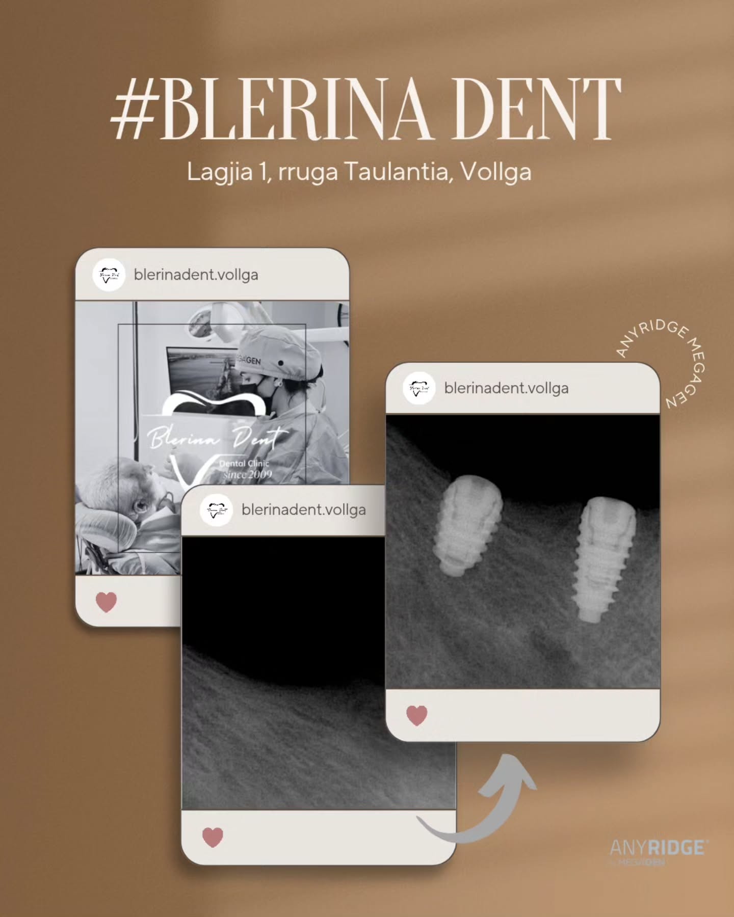 Implanti Dentali