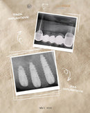 Implanti Dentali