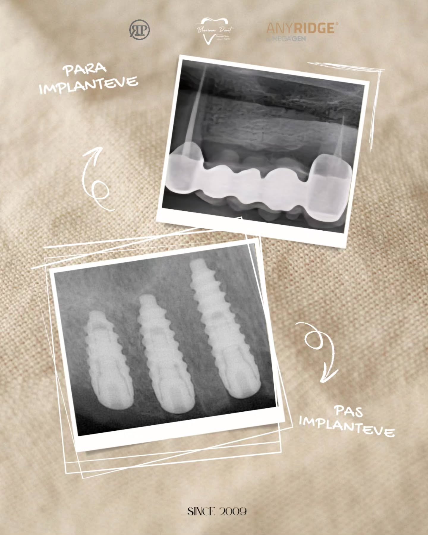 Implanti Dentali