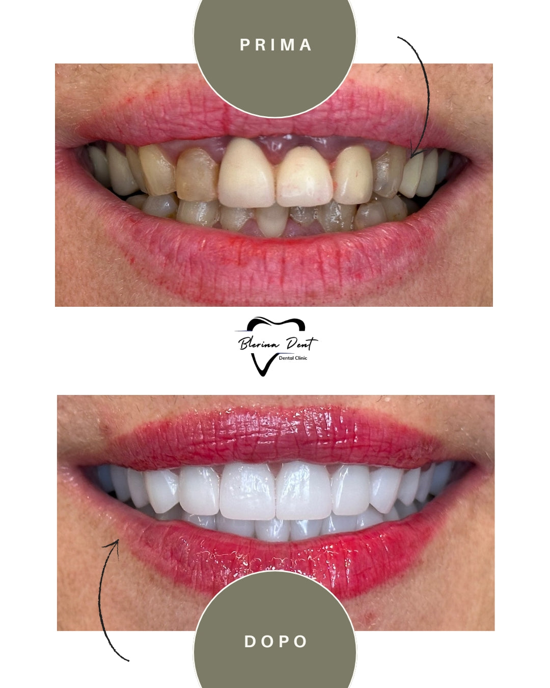 Corone in Zirconia Standard & Monolitica (full zirconia)