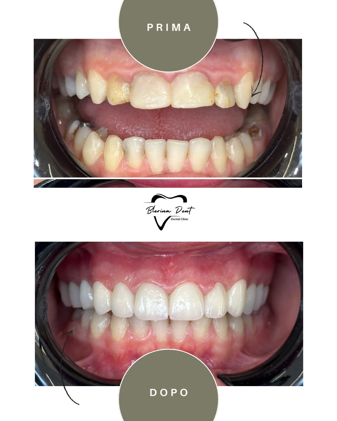 Corone in Zirconia Standard & Monolitica (full zirconia)