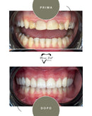 Corone in Zirconia Standard & Monolitica (full zirconia)