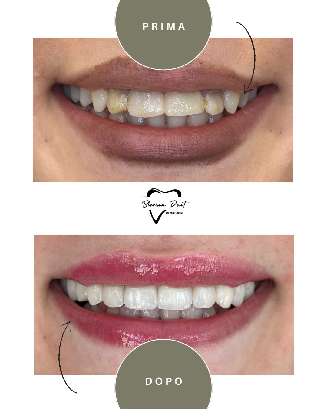 Corone in Zirconia Standard & Monolitica (full zirconia)