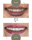Corone in Zirconia Standard & Monolitica (full zirconia)