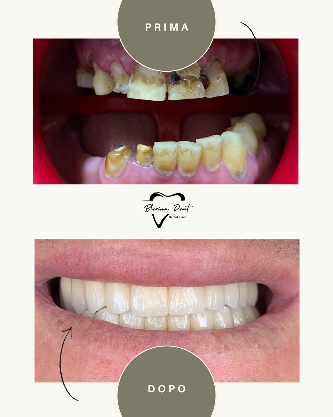 Corone metallo-ceramica: estetica e resistenza in un unico trattamento
