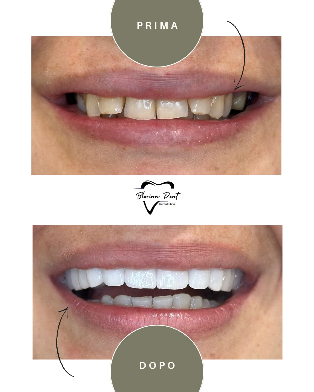 Corone in Zirconia Standard & Monolitica (full zirconia)
