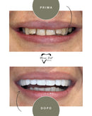 Corone in Zirconia Standard & Monolitica (full zirconia)
