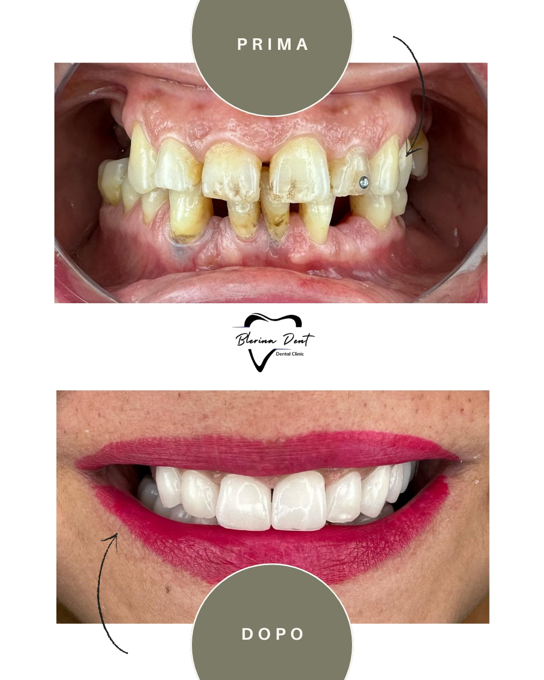 Corone in Zirconia Standard & Monolitica (full zirconia)