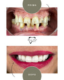 Corone in Zirconia Standard & Monolitica (full zirconia)