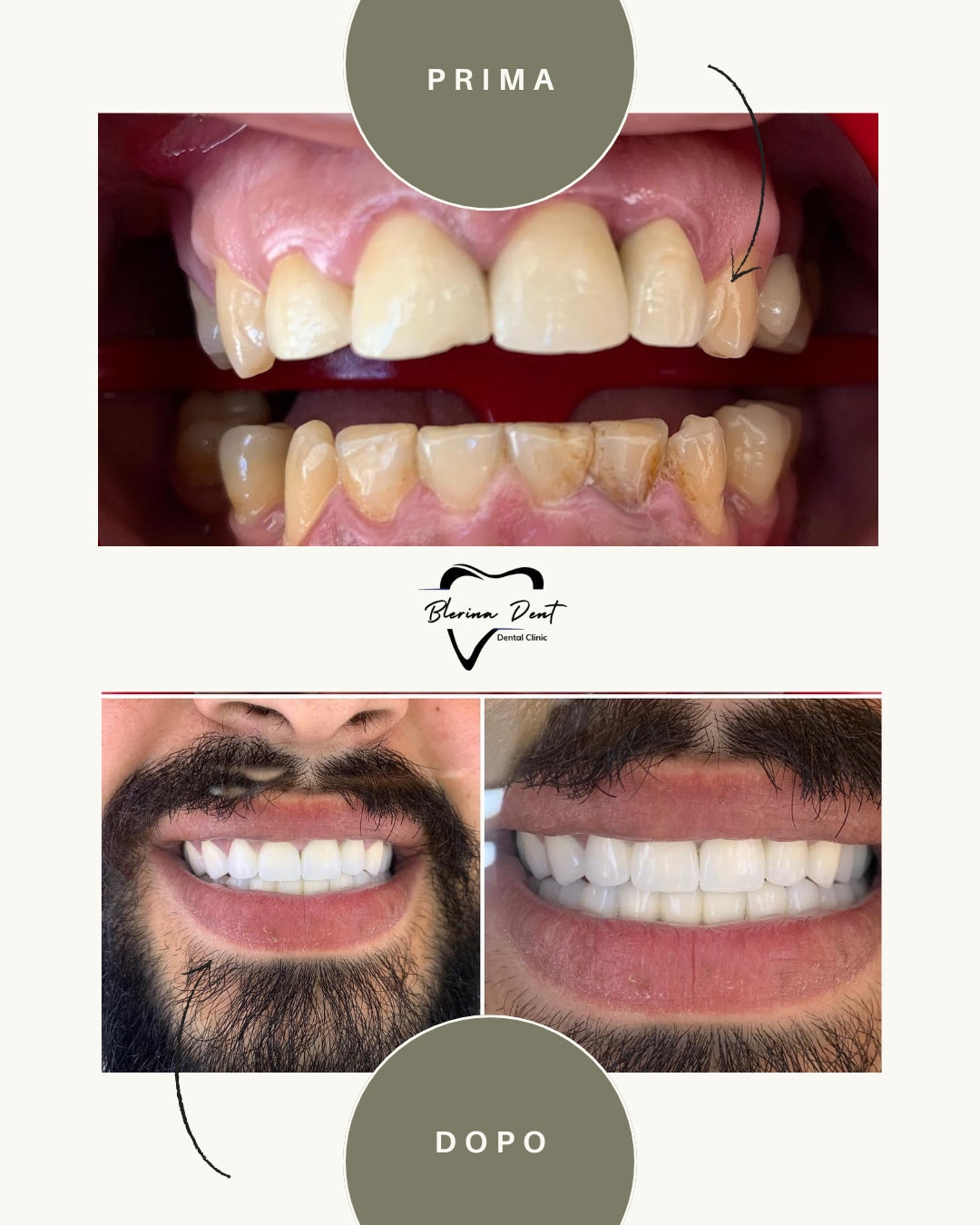 Corone metallo-ceramica: estetica e resistenza in un unico trattamento