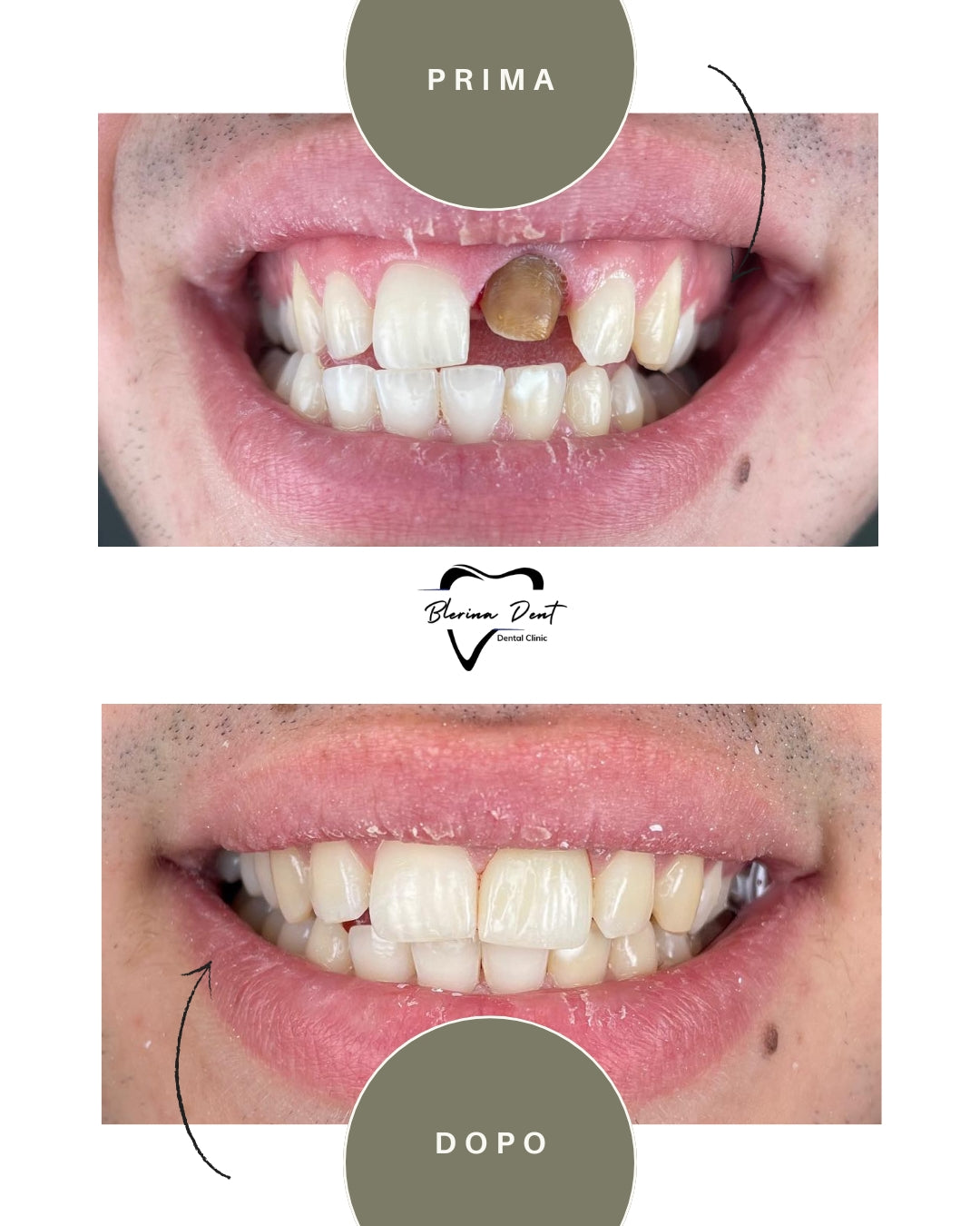 Corone in Zirconia Standard & Monolitica (full zirconia)