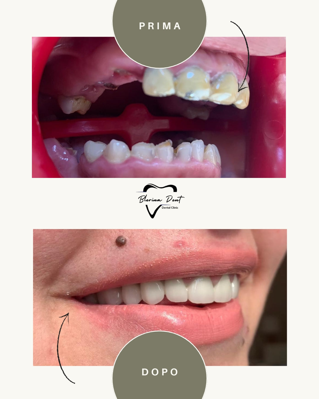 Corone metallo-ceramica: estetica e resistenza in un unico trattamento