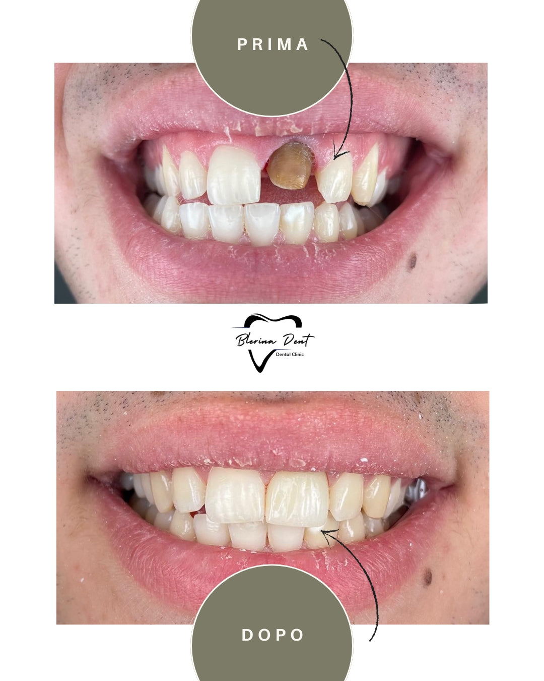 Corone in Zirconia Standard & Monolitica (full zirconia)
