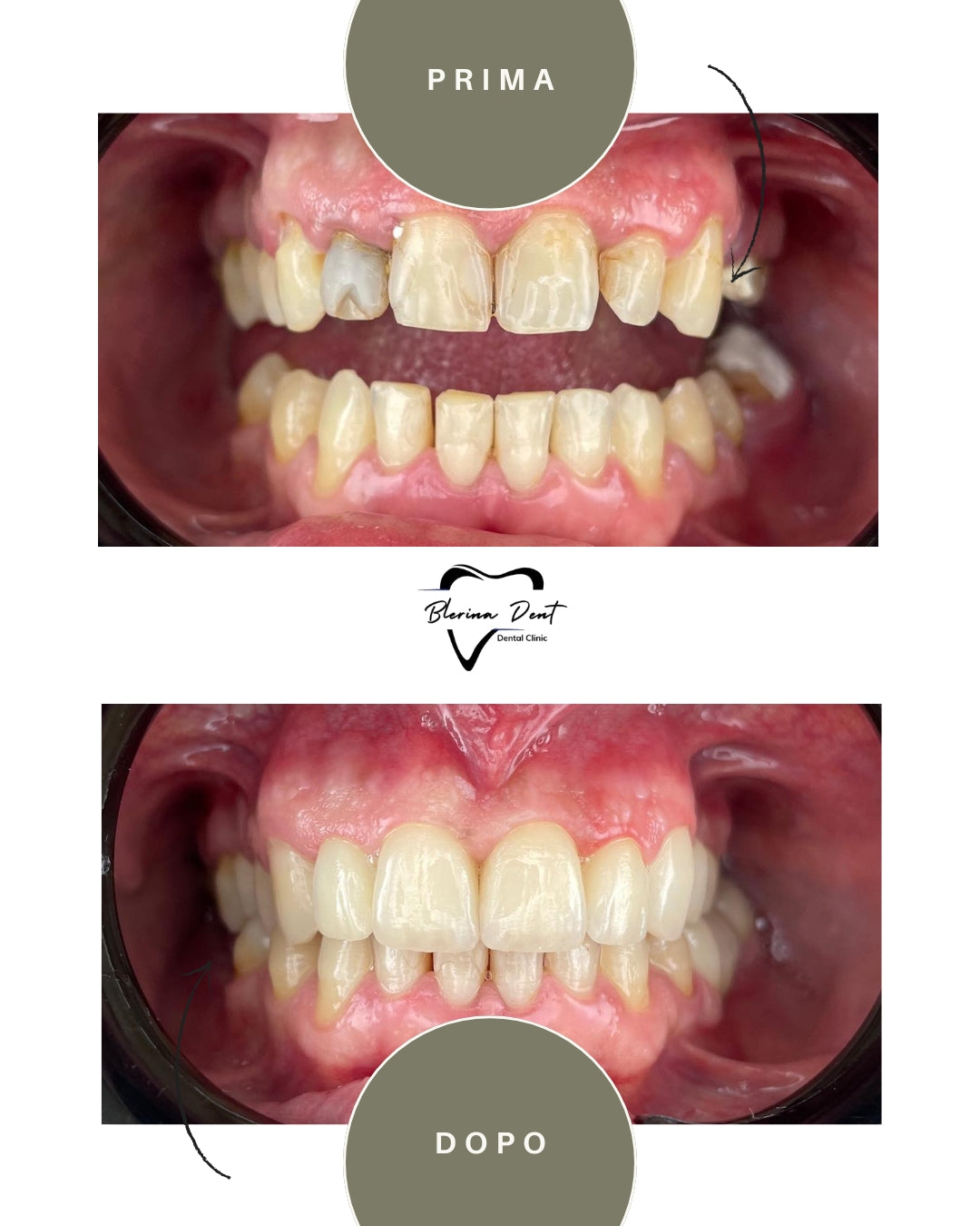 Corone in Zirconia Standard & Monolitica (full zirconia)