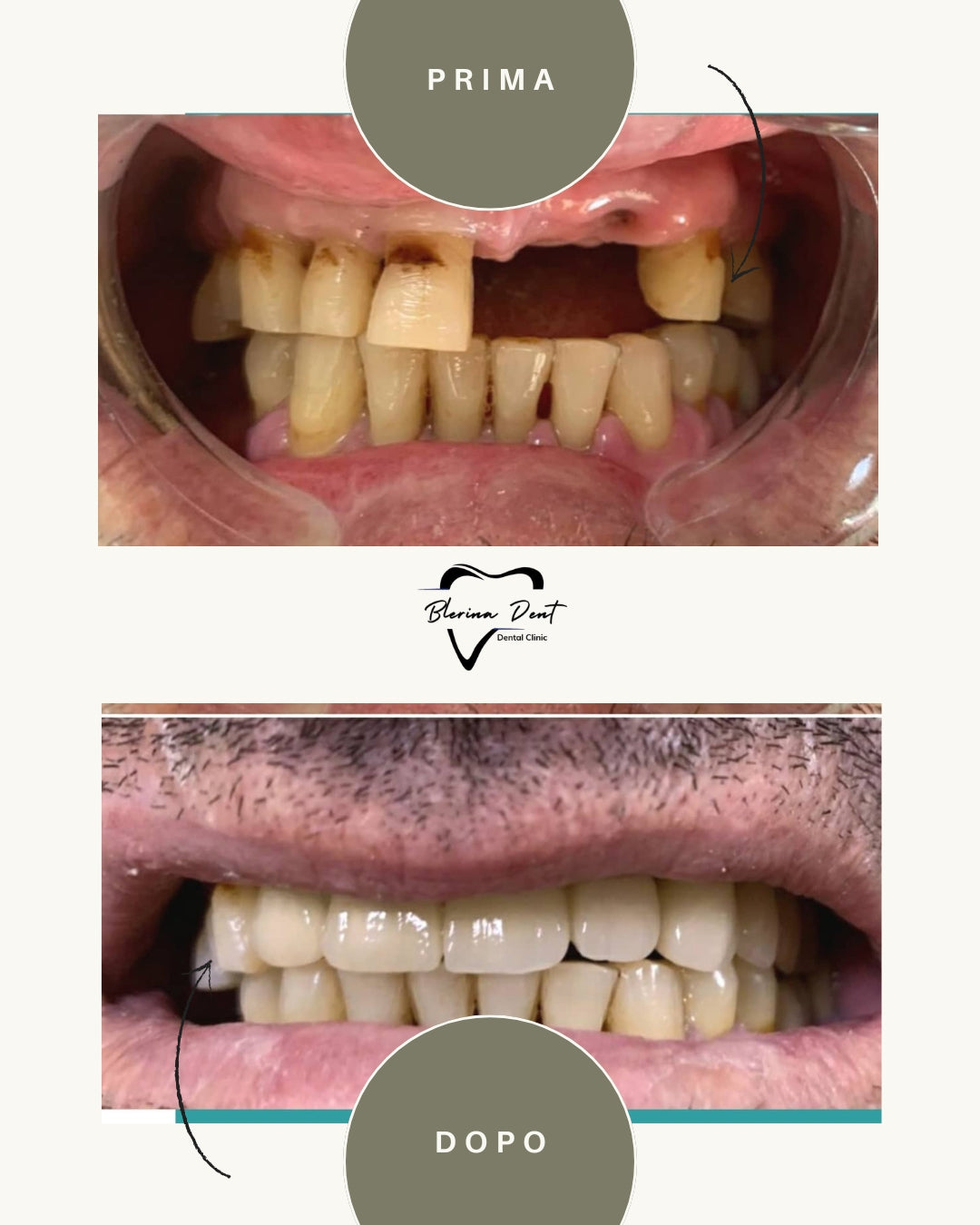 Corone metallo-ceramica: estetica e resistenza in un unico trattamento