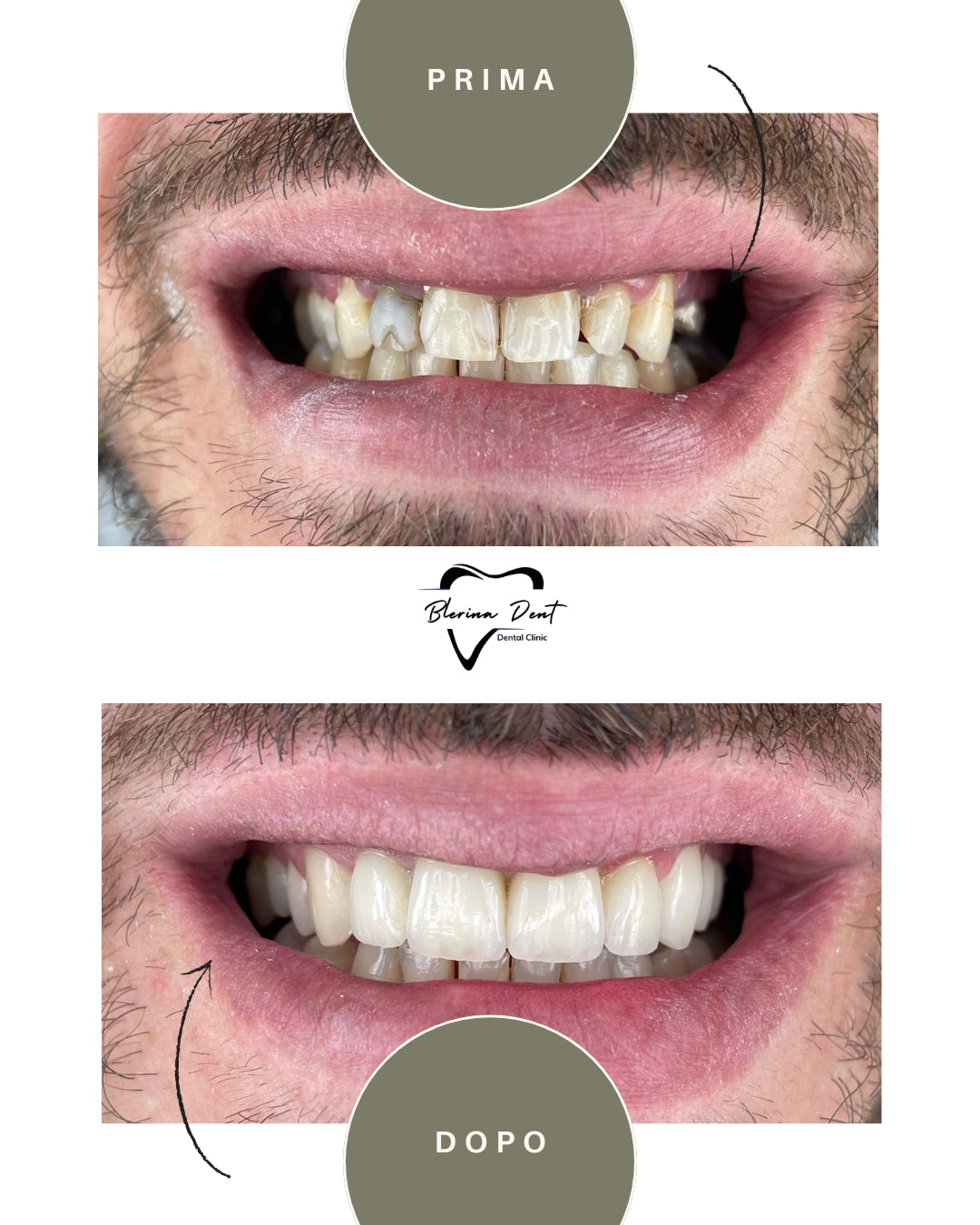 Corone in Zirconia Standard & Monolitica (full zirconia)