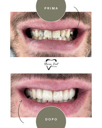 Corone in Zirconia Standard & Monolitica (full zirconia)