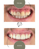 Corone in Zirconia Standard & Monolitica (full zirconia)
