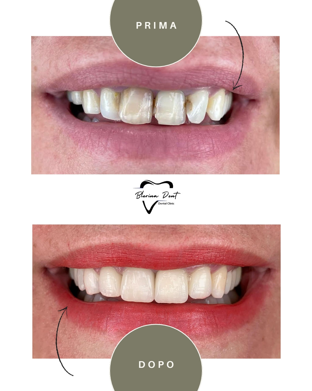 Corone in Zirconia Standard & Monolitica (full zirconia)
