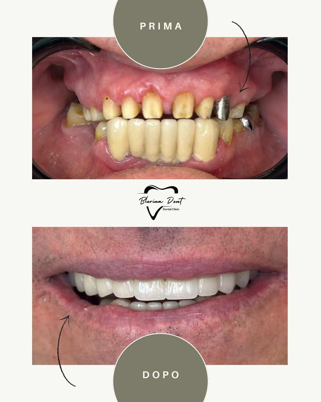Corone metallo-ceramica: estetica e resistenza in un unico trattamento