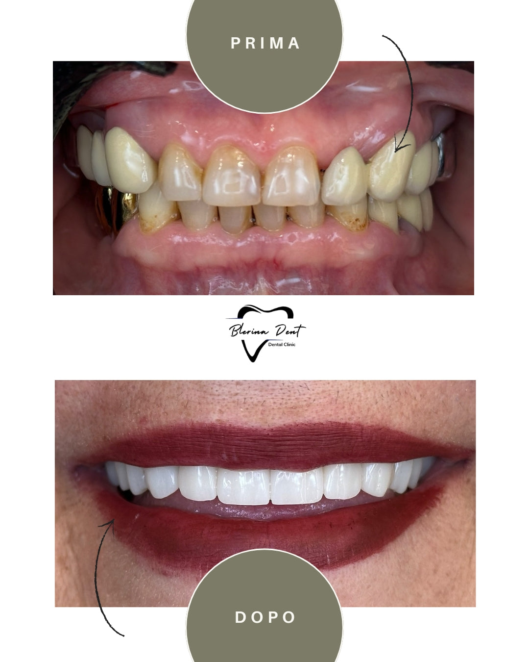 Corone in Zirconia Standard & Monolitica (full zirconia)
