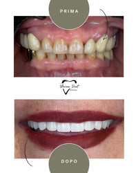 Corone in Zirconia Standard & Monolitica (full zirconia)
