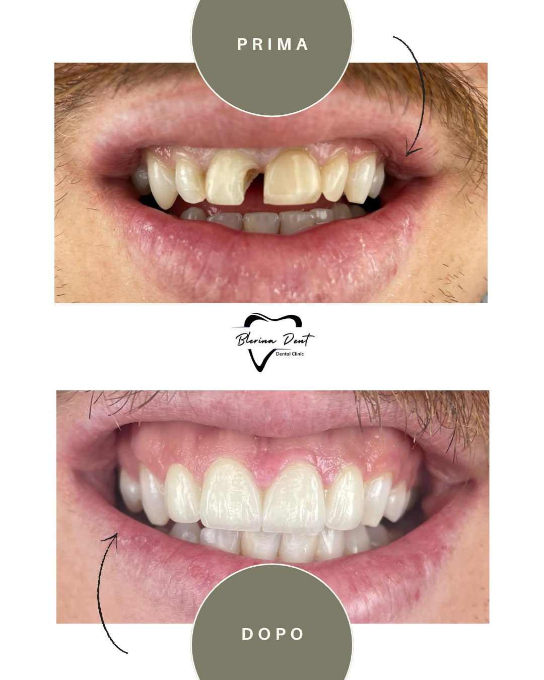 Corone in Zirconia Standard & Monolitica (full zirconia)