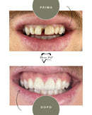 Corone in Zirconia Standard & Monolitica (full zirconia)
