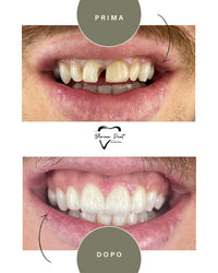 Corone in Zirconia Standard & Monolitica (full zirconia)