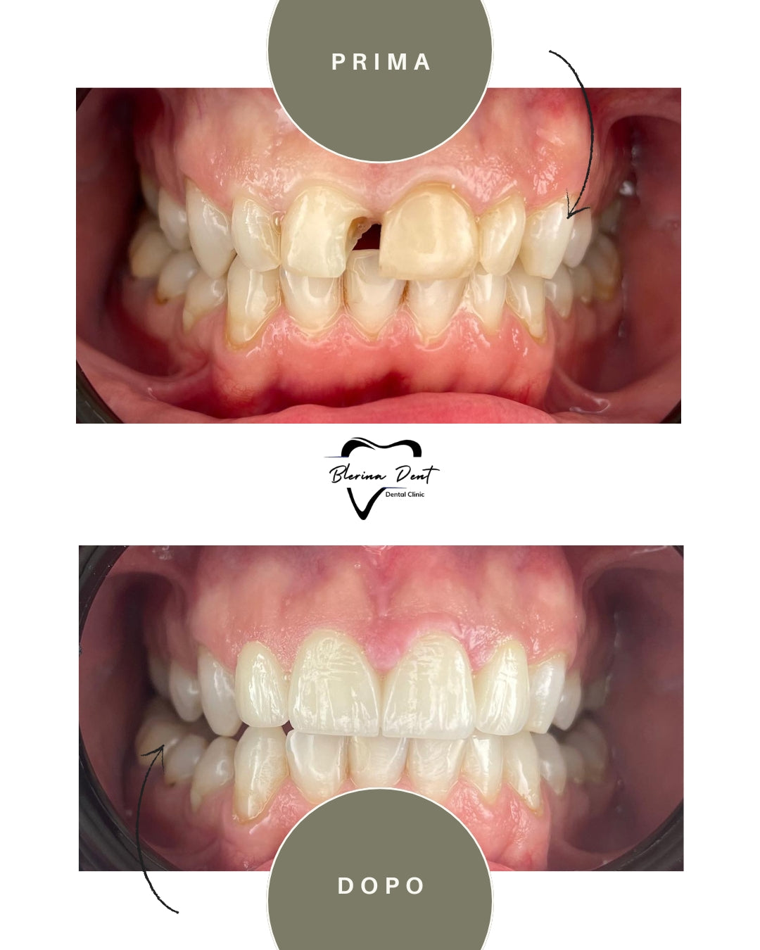 Corone in Zirconia Standard & Monolitica (full zirconia)