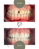 Corone in Zirconia Standard & Monolitica (full zirconia)