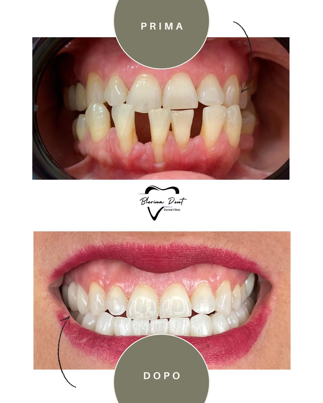 Corone in Zirconia Standard & Monolitica (full zirconia)