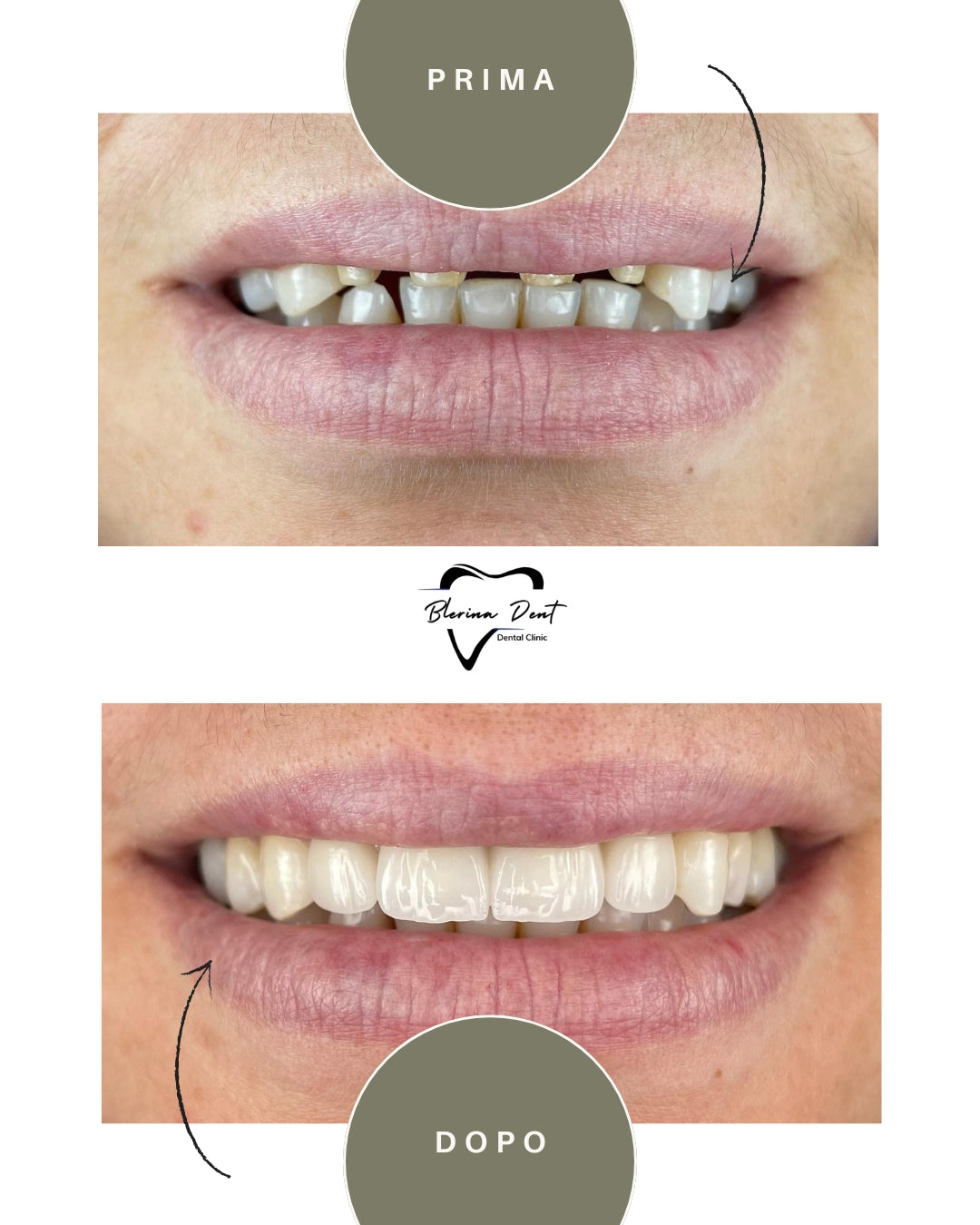 Corone in Zirconia Standard & Monolitica (full zirconia)