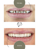 Corone in Zirconia Standard & Monolitica (full zirconia)