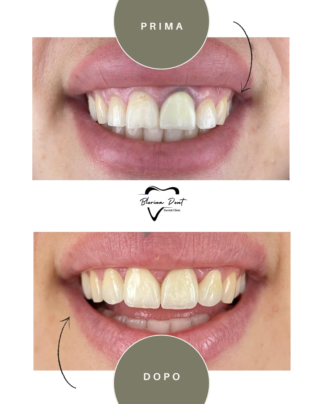 Corone in Zirconia Standard & Monolitica (full zirconia)
