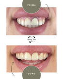 Corone in Zirconia Standard & Monolitica (full zirconia)