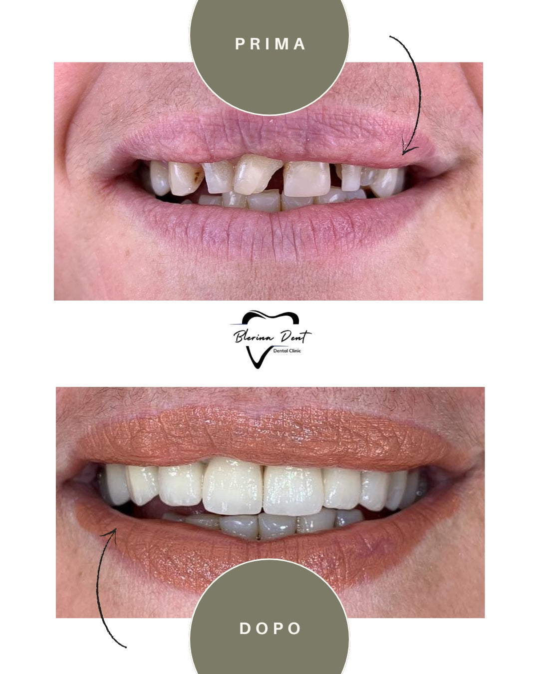 Corone in Zirconia Standard & Monolitica (full zirconia)