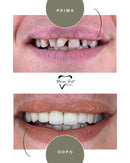 Corone in Zirconia Standard & Monolitica (full zirconia)