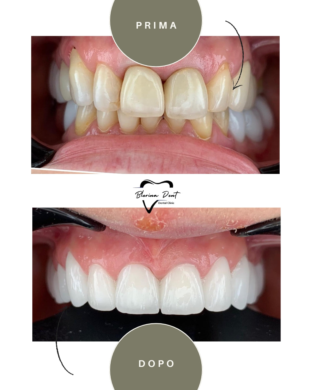 Corone in Zirconia Standard & Monolitica (full zirconia)