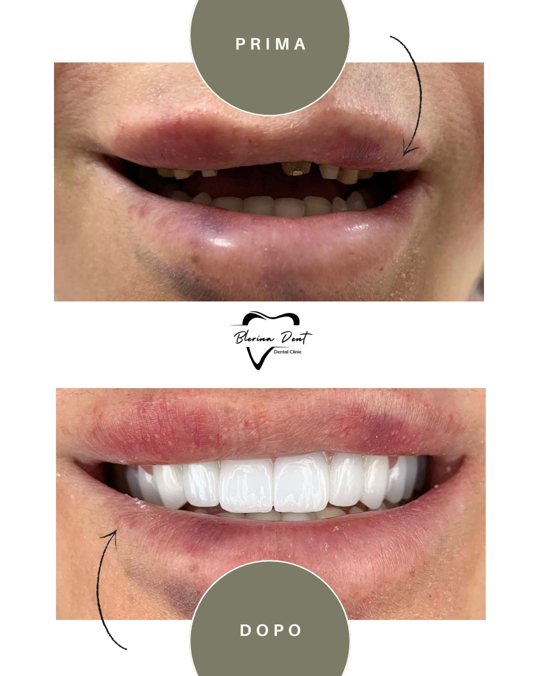Corone in Zirconia Standard & Monolitica (full zirconia)