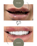 Corone in Zirconia Standard & Monolitica (full zirconia)