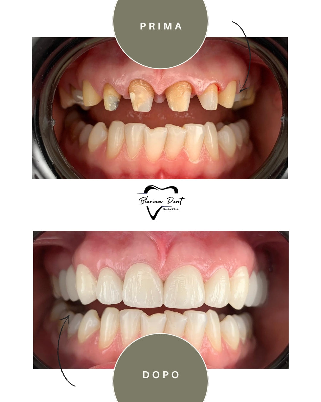 Corone in Zirconia Standard & Monolitica (full zirconia)