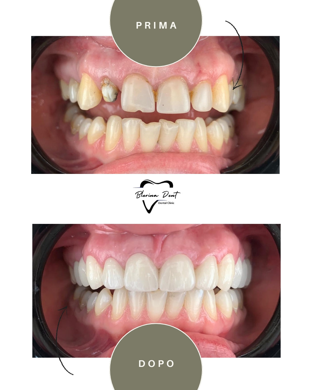 Corone in Zirconia Standard & Monolitica (full zirconia)